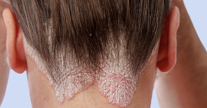 All About Psoriasis image