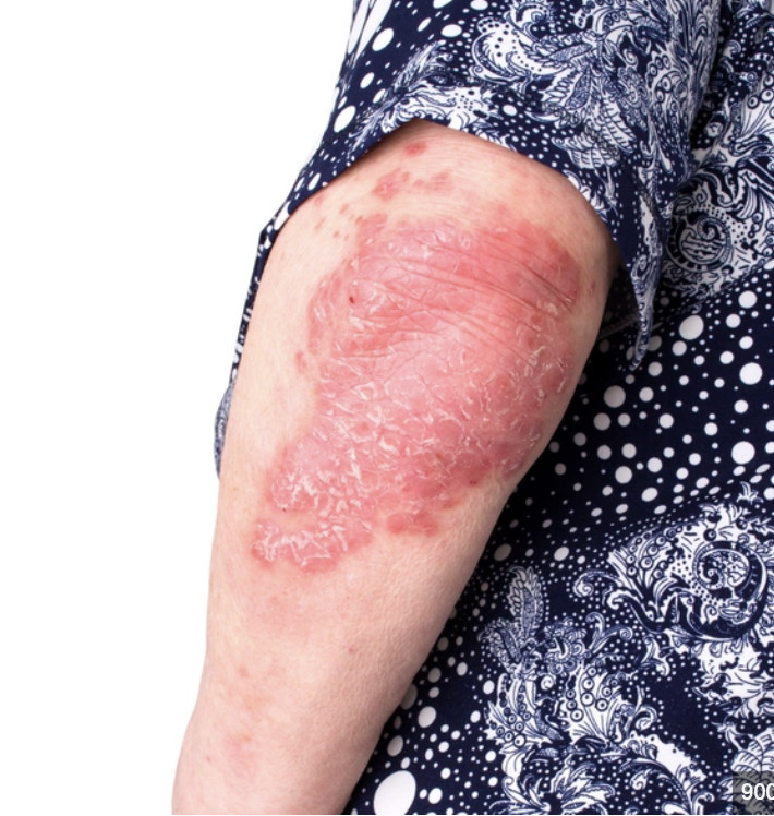 psoriasis