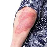 psoriasis