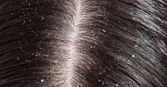 Treating Dandruff with Chinese Herbal Medicine image